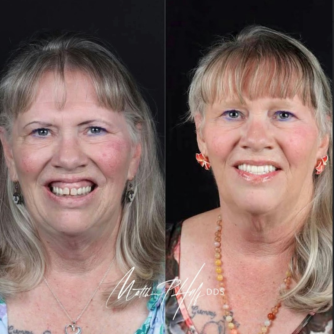 Before and after veneer treatment showing natural smile enhancement