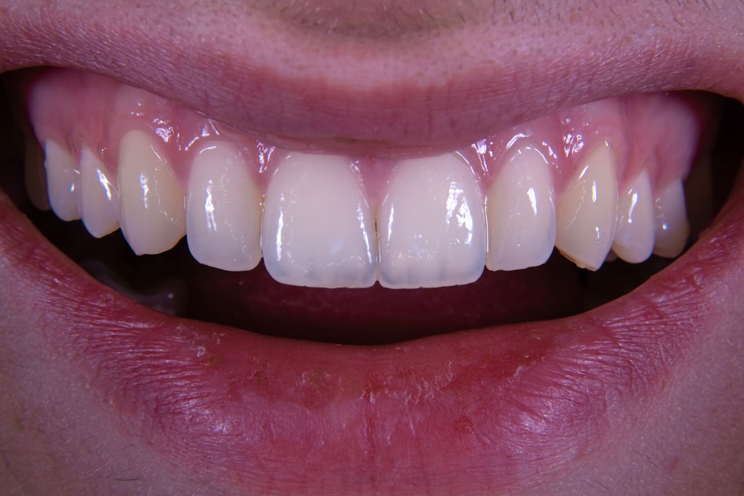 Before and after veneer treatment showing natural smile enhancement